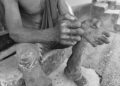 A man affected by leprosy sits barefoot on a concrete platform at Suakoko Rehabilitation Center, Bong County, Liberia, showing damaged limbs and torn clothing.