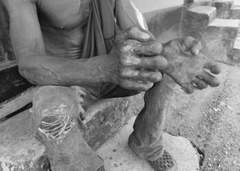 A man affected by leprosy sits barefoot on a concrete platform at Suakoko Rehabilitation Center, Bong County, Liberia, showing damaged limbs and torn clothing.