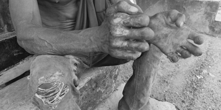 A man affected by leprosy sits barefoot on a concrete platform at Suakoko Rehabilitation Center, Bong County, Liberia, showing damaged limbs and torn clothing.