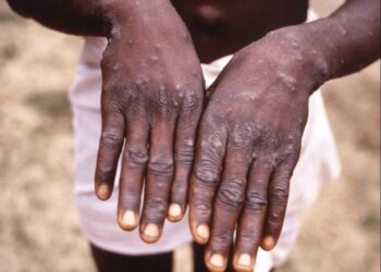 A close-up image of a person’s hands showing multiple pus-filled skin lesions caused by Mpox (Monkeypox). The individual is standing outdoors and wearing white shorts