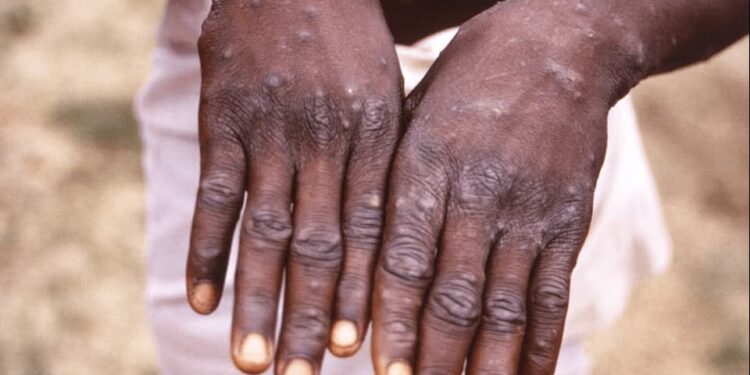 A close-up image of a person’s hands showing multiple pus-filled skin lesions caused by Mpox (Monkeypox). The individual is standing outdoors and wearing white shorts
