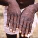A close-up image of a person’s hands showing multiple pus-filled skin lesions caused by Mpox (Monkeypox). The individual is standing outdoors and wearing white shorts