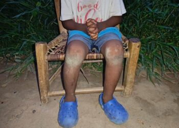 A young boy sits with hands clasped and legs bruised, representing child trauma and neglect in rural Bong County, Liberia
