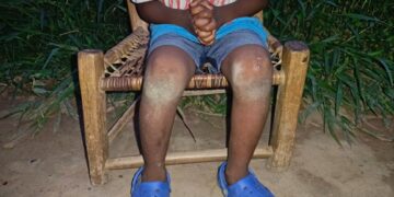 A young boy sits with hands clasped and legs bruised, representing child trauma and neglect in rural Bong County, Liberia