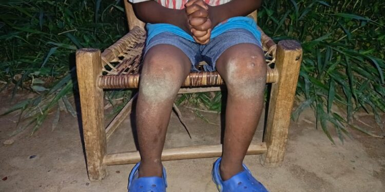 A young boy sits with hands clasped and legs bruised, representing child trauma and neglect in rural Bong County, Liberia