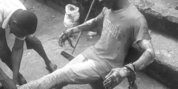 Survivor with burn injuries sitting on steps following Mira Oxygen blast in Liberia
