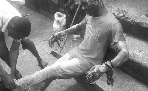 Survivor with burn injuries sitting on steps following Mira Oxygen blast in Liberia