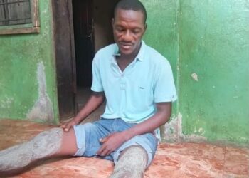 Injured House worker Alvin N. Jabbeh sits on the floor showing his injured legs after allegedly being assaulted at Deputy Speaker Thomas Fallah’s residence in Johnsonville