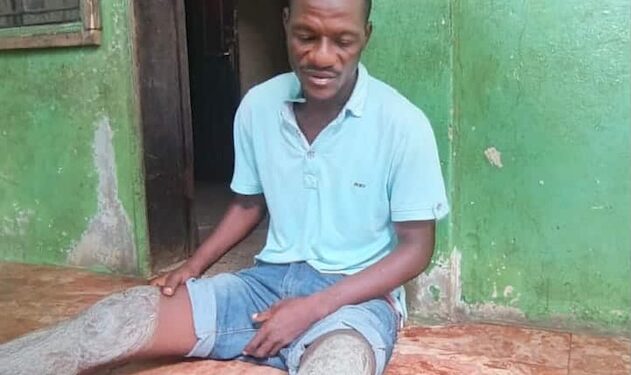 Injured House worker Alvin N. Jabbeh sits on the floor showing his injured legs after allegedly being assaulted at Deputy Speaker Thomas Fallah’s residence in Johnsonville