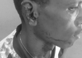 Injured victim receiving medical care after alleged ear-biting assault in Kakata, Margibi County.