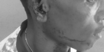 Injured victim receiving medical care after alleged ear-biting assault in Kakata, Margibi County.